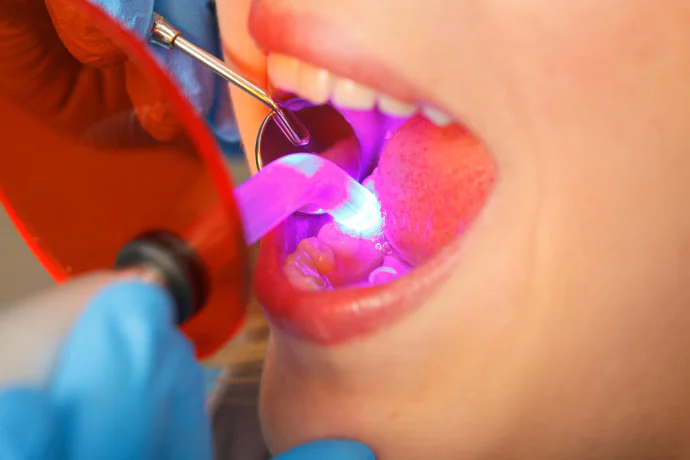 Dental Bonding