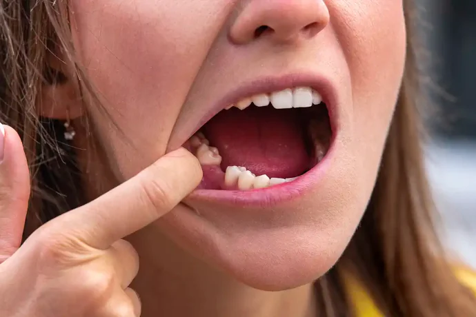 Dental Bridge Smile Repair in Hopewell, VA