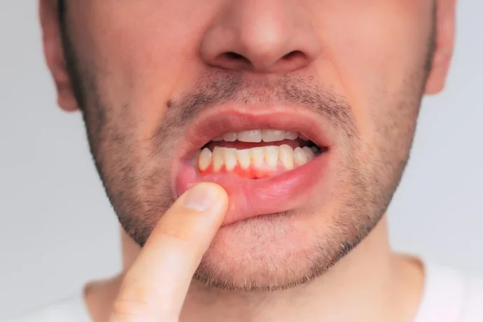 Gum Disease Treatment