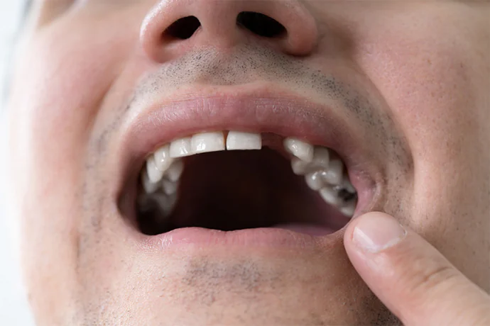 What to do for a missing tooth