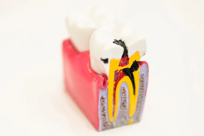 Root Canal Treatment