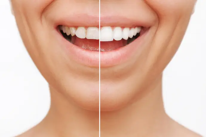 Smile Makeover