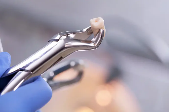 Tooth Extractions