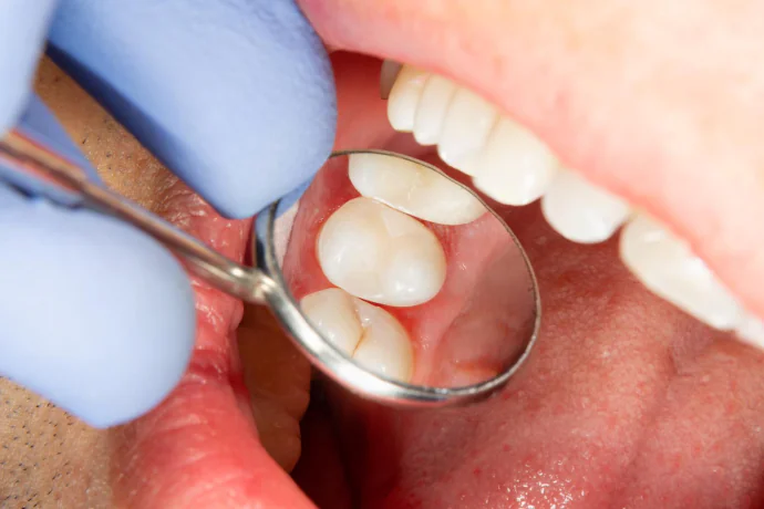 Fillings and Sealants